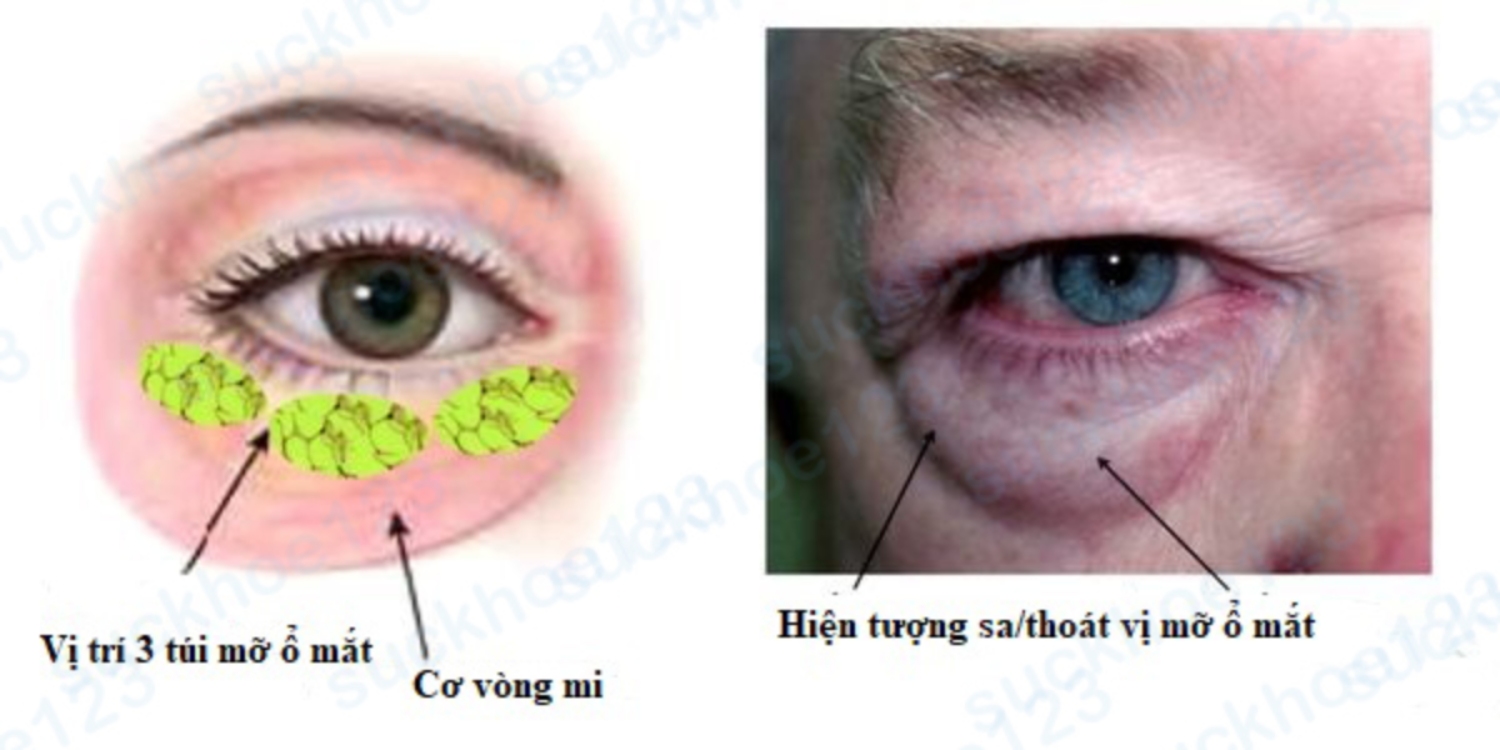 hình ảnh túi mỡ ổ mắt