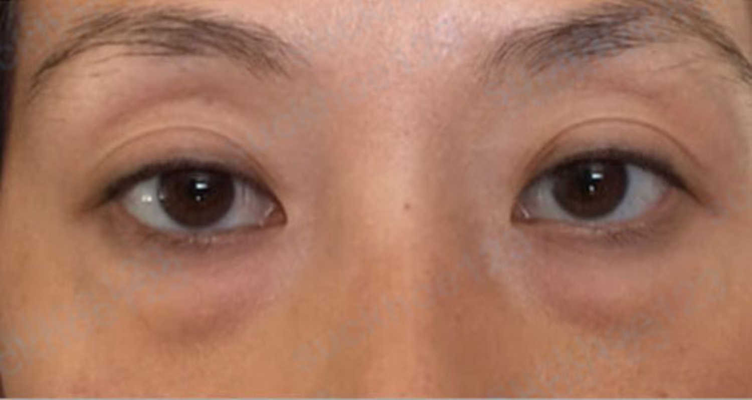 Phẫu thuật thẩm mỹ mắt là gì Có những loại nào Bảng giá