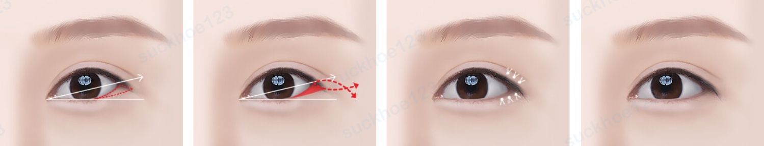 mở góc mắt ngoài