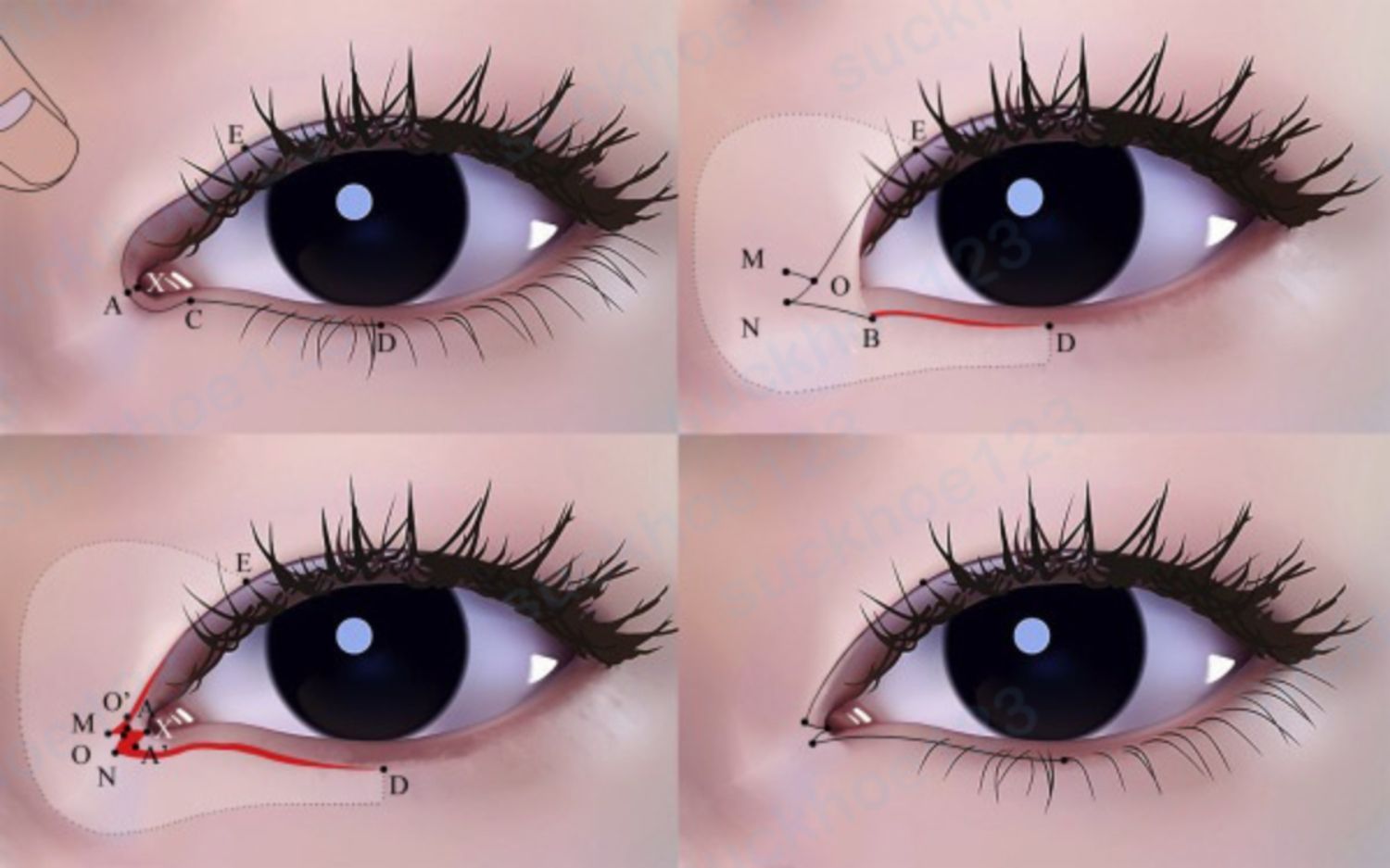 mở góc mắt trong