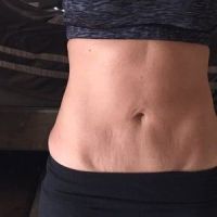 Sau khi tạo hình thành bụng mini thì còn có thể tạo hình thành bụng toàn phần không?