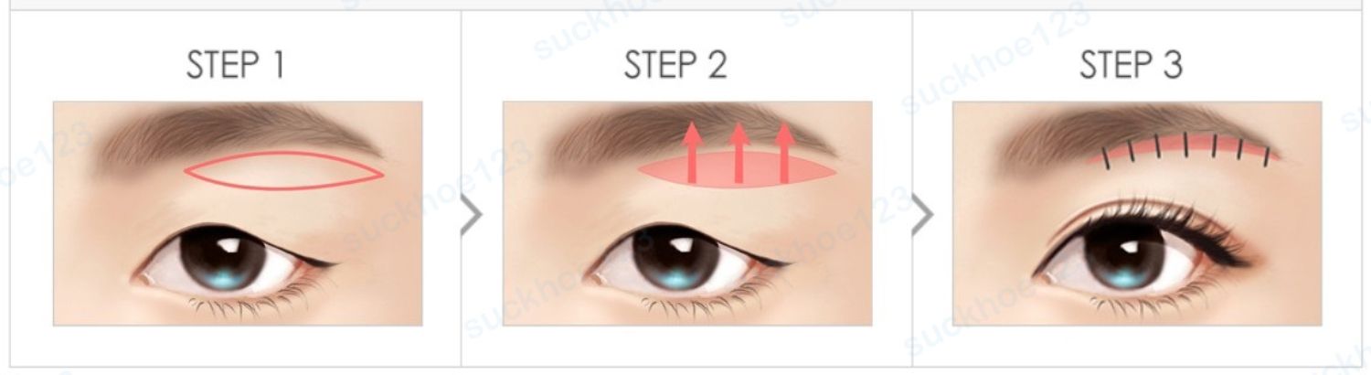 subbrow lift