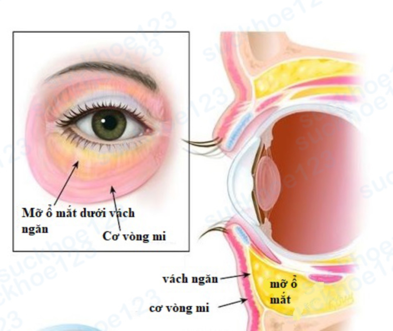 vị trí mỡ ổ mắt
