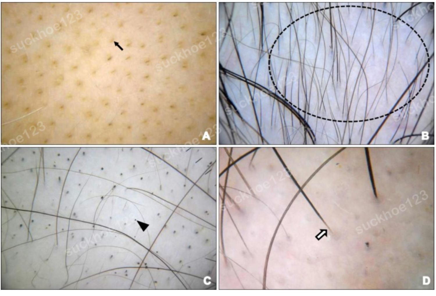 Dermoscopy da đầu