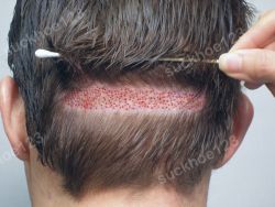 Các biến chứng có thể gặp phải sau cấy tóc tự thân