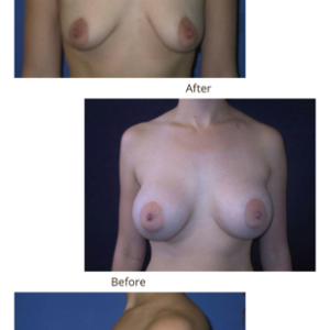 Tôi đã ngừng cho con bú từ 3 tháng trước, ngực bị xẹp, liệu tôi cần nâng ngực hay treo ngực sa trễ?