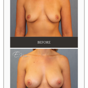 Tôi đã ngừng cho con bú từ 3 tháng trước, ngực bị xẹp, liệu tôi cần nâng ngực hay treo ngực sa trễ?