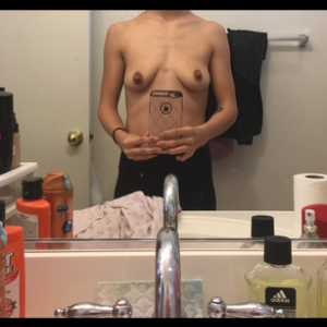 Tôi đã ngừng cho con bú từ 3 tháng trước, ngực bị xẹp, liệu tôi cần nâng ngực hay treo ngực sa trễ?