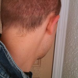 Tôi đã cấy 3500 nang tóc sau gần 1 tháng (phương pháp FUE), vùng cho tóc vẫn còn bị đỏ rất nhiều, có bình thường không ạ?