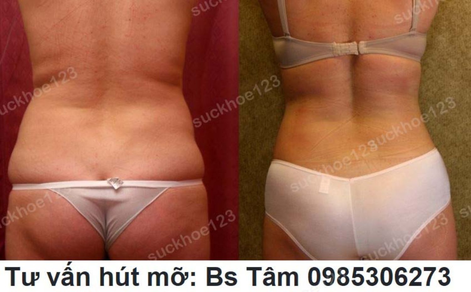 hut mo bac si tam ca 12 3