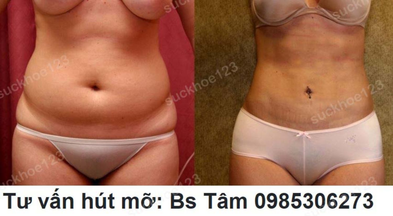 hut mo bac si tam ca 12