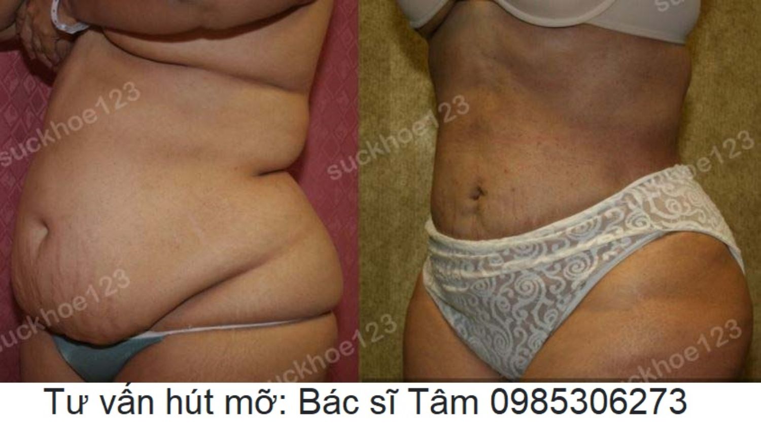 hut mo bac si tam ca 22 1