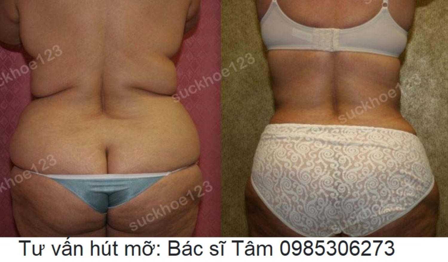 hut mo bac si tam ca 22 2