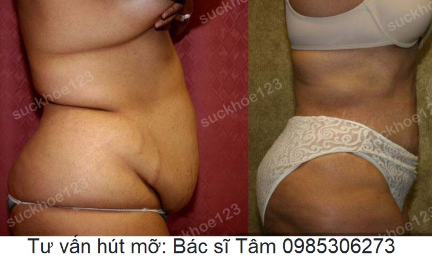 hut mo bac si tam ca 22 3