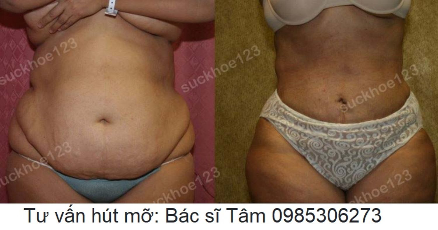 hut mo bac si tam ca 22