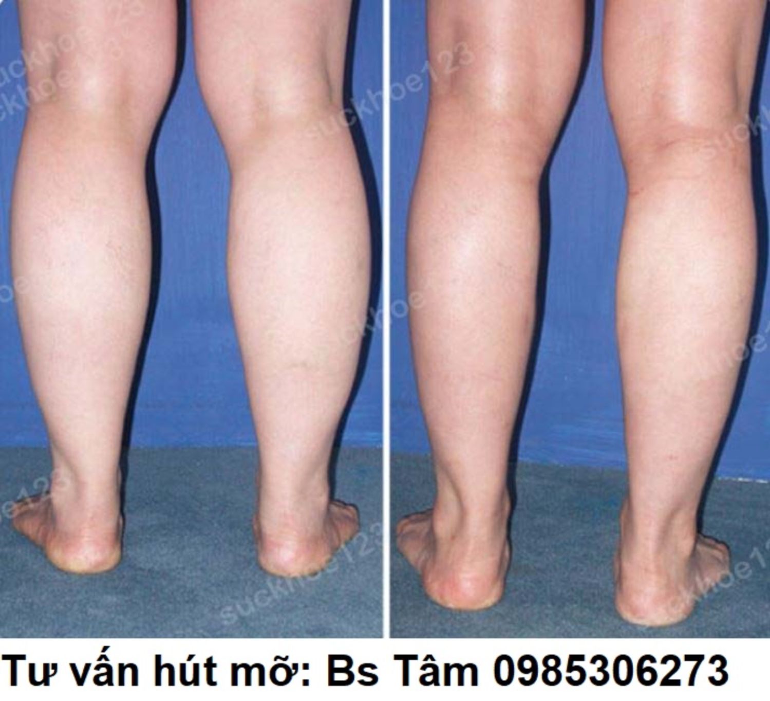 hut mo bac si tam ca 49