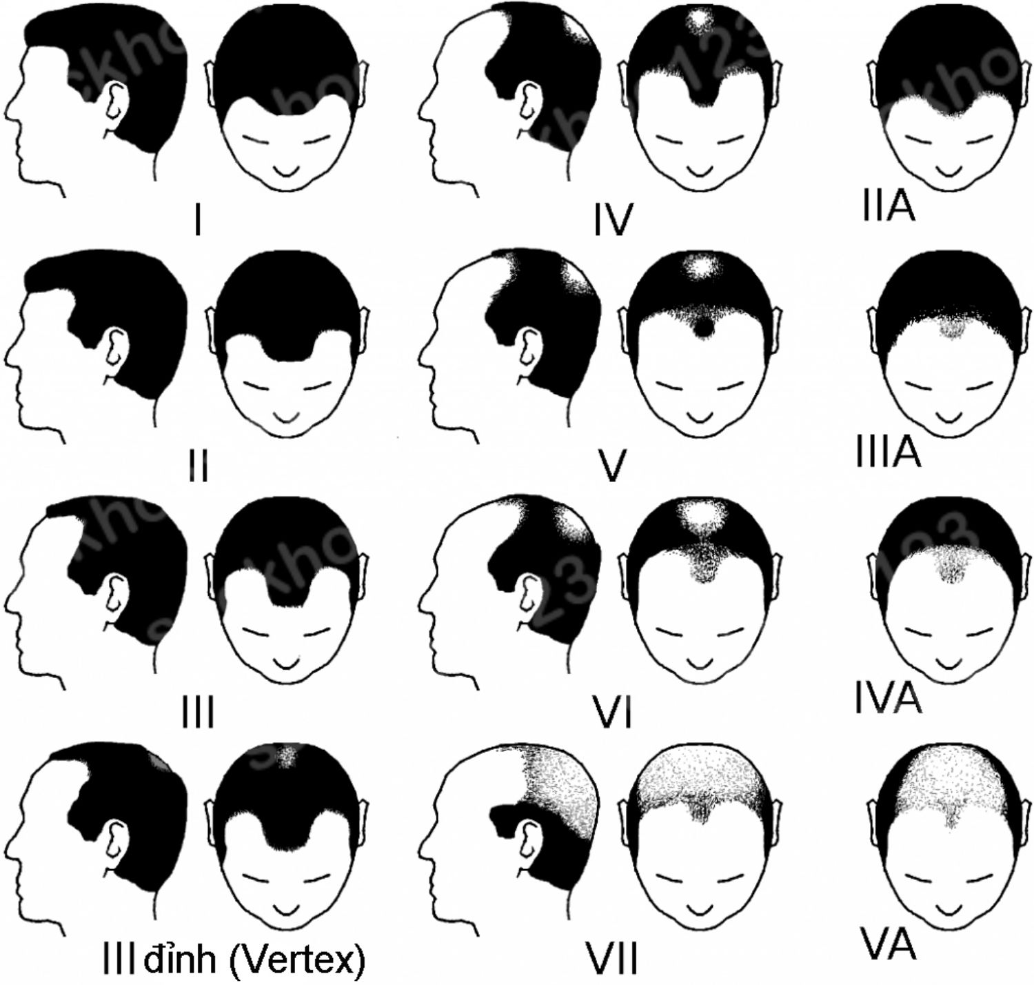 Phương pháp phân loại rụng tóc Norwood