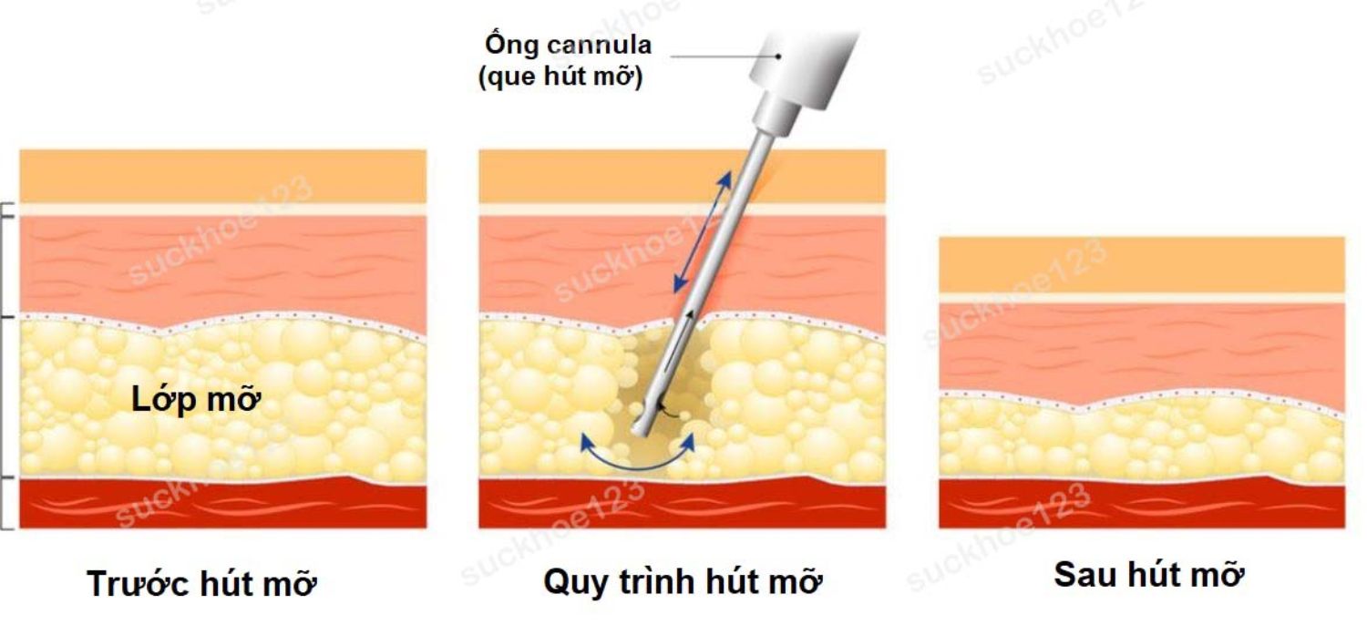 soc ong cannula