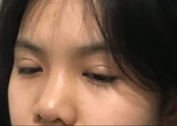 Sửa mí hay mở góc mắt