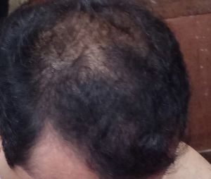 Cấy 3000 cụm nang tóc thì có nhiều quá không?