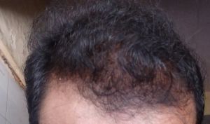 Cấy 3000 cụm nang tóc thì có nhiều quá không?