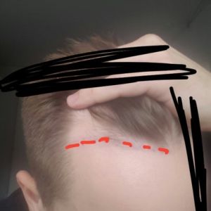 Tôi không muốn cấy tóc số lượng lớn, có thể chỉ cấy 700-900 cụm nang tóc được không?