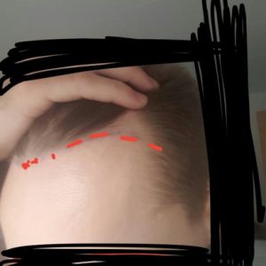 Tôi không muốn cấy tóc số lượng lớn, có thể chỉ cấy 700-900 cụm nang tóc được không?