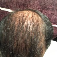 Tôi đã cấy 5700 mảnh ghép tóc từ 9 tháng trước, da đầu vẫn lộ rõ như thể khi tôi bị hói, lúc nào thì tóc mới phủ kín da đầu?