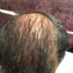 Tôi đã cấy 5700 mảnh ghép tóc từ 9 tháng trước, da đầu vẫn lộ rõ như thể khi tôi bị hói, lúc nào thì tóc mới phủ kín da đầu?