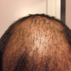 Tôi sợ mật độ tóc không đủ dày sau ca cấy tóc của tôi, liệu tóc của tôi có thể che kín đầu không?