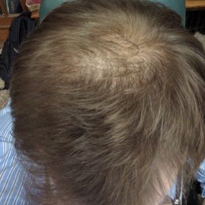 Tôi muốn làm thẳng đường chân tóc mà vẫn đảm bảo mật độ tóc tự nhiên chỉ trong một ca cấy tóc, có được hay không?