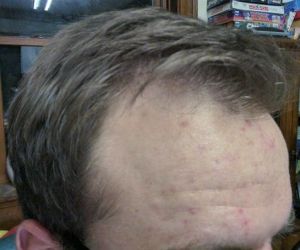 Tôi muốn làm thẳng đường chân tóc mà vẫn đảm bảo mật độ tóc tự nhiên chỉ trong một ca cấy tóc, có được hay không?