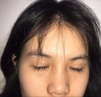 Sửa mí hay mở góc mắt