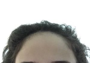 Nên chọn kỹ thuật FUT (cắt dải nang tóc) hay FUE (chiết cụm nang tóc) để cấy tóc nhằm hạ đường chân tóc?