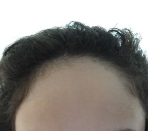 Nên chọn kỹ thuật FUT (cắt dải nang tóc) hay FUE (chiết cụm nang tóc) để cấy tóc nhằm hạ đường chân tóc?