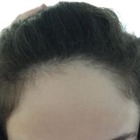 Nên chọn kỹ thuật FUT (cắt dải nang tóc) hay FUE (chiết cụm nang tóc) để cấy tóc nhằm hạ đường chân tóc?