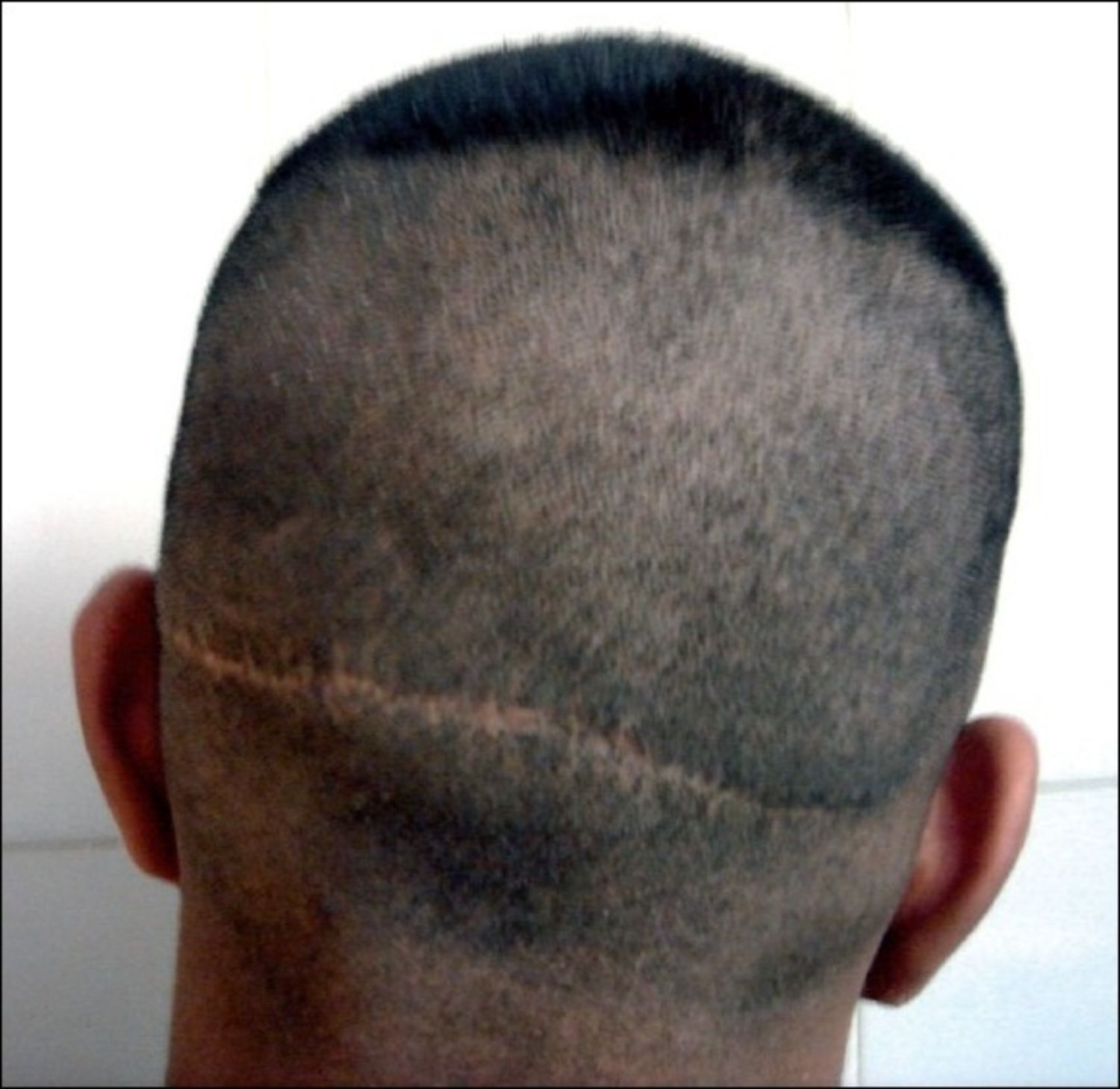 Hình ảnh vùng cho tóc sau fut