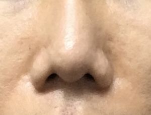 Cánh mũi bị xệ và đầu mũi có rãnh