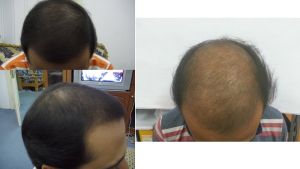 Rụng tóc sau khi cấy 6 tháng?