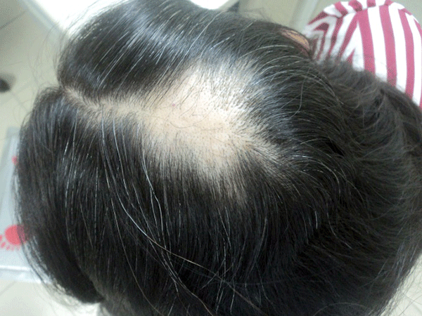 rụng tóc từng vùng thành dát