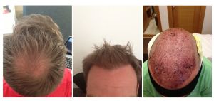 Tóc bình thường của tôi không mọc sau khi làm cấy tóc?