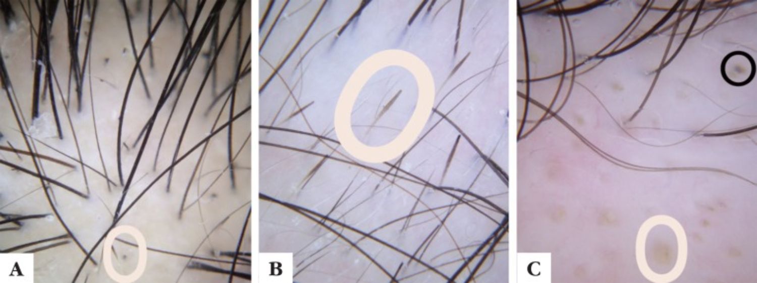 soi da chẩn đoán DAA