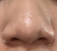 Mũi mình tiêm filler có cải thiện được gì không ạ?