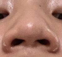 Mũi mình tiêm filler có cải thiện được gì không ạ?