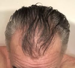 Tôi năm nay 57 tuổi, đã đến lúc làm cấy tóc chưa?