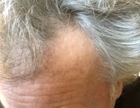 Tôi năm nay 57 tuổi, đã đến lúc làm cấy tóc chưa?