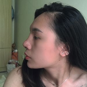 Sống mũi ở hốc mắt có gom thấp xuống không