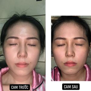 Nâng mũi được 47ngày có thể tháo sụn ra được không ?