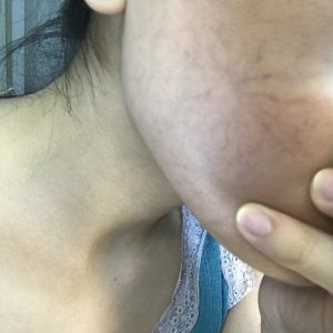 Da hiện mao mạch thì phải làm gì để can thiệp ?