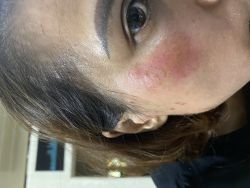 Da bị đỏ và châm chích sau điều trị lazer kết hợp peel da